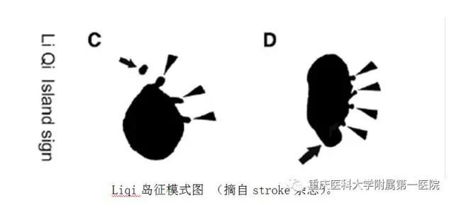 重磅!国际上首次以中国人名字命名脑血管疾病